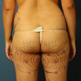 A front view before photo of patient 281 that underwent Brazilian Butt Lift:Liposuction procedures at Memorial Plastic Surgery
