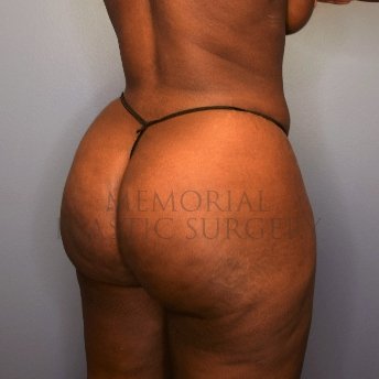 A oblique view after photo of patient 2674 that underwent Brazilian Butt Lift:Liposuction procedures at Memorial Plastic Surgery