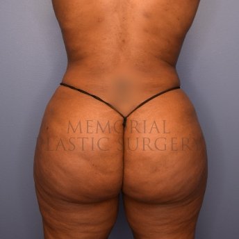 A oblique view after photo of patient 1382 that underwent Brazilian Butt Lift:Liposuction procedures at Memorial Plastic Surgery