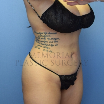 A oblique view after photo of patient 4103 that underwent Brazilian Butt Lift:Liposuction procedures at Memorial Plastic Surgery