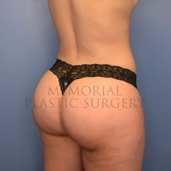 A oblique view after photo of patient 2519 that underwent Brazilian Butt Lift:Liposuction procedures at Memorial Plastic Surgery