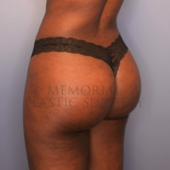A oblique view after photo of patient 1413 that underwent Brazilian Butt Lift:Liposuction procedures at Memorial Plastic Surgery
