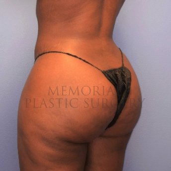 A oblique view after photo of patient 1267 that underwent Brazilian Butt Lift:Liposuction procedures at Memorial Plastic Surgery