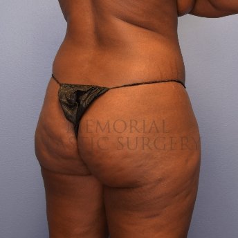 A oblique view before photo of patient 2674 that underwent Brazilian Butt Lift:Liposuction procedures at Memorial Plastic Surgery