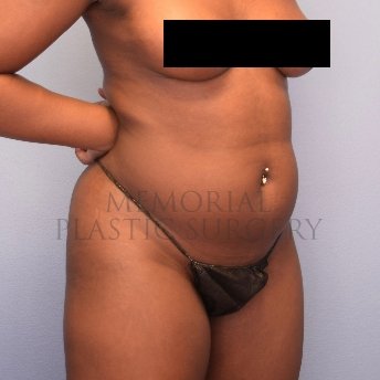 A oblique view before photo of patient 2652 that underwent Brazilian Butt Lift:Liposuction procedures at Memorial Plastic Surgery