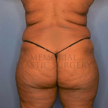 A oblique view before photo of patient 1382 that underwent Brazilian Butt Lift:Liposuction procedures at Memorial Plastic Surgery