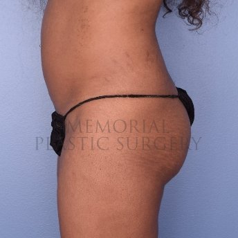 A oblique view before photo of patient 2523 that underwent Brazilian Butt Lift:Liposuction procedures at Memorial Plastic Surgery