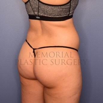 A oblique view before photo of patient 2519 that underwent Brazilian Butt Lift:Liposuction procedures at Memorial Plastic Surgery