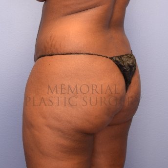 A oblique view before photo of patient 1267 that underwent Brazilian Butt Lift:Liposuction procedures at Memorial Plastic Surgery