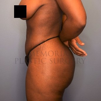 A side view after photo of patient 2674 that underwent Brazilian Butt Lift:Liposuction procedures at Memorial Plastic Surgery