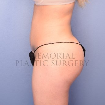 A side view after photo of patient 2390 that underwent Brazilian Butt Lift:Liposuction procedures at Memorial Plastic Surgery