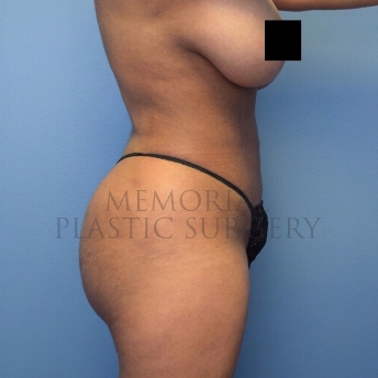 A side view after photo of patient 4107 that underwent Brazilian Butt Lift:Liposuction procedures at Memorial Plastic Surgery
