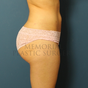 A side view after photo of patient 281 that underwent Brazilian Butt Lift:Liposuction procedures at Memorial Plastic Surgery