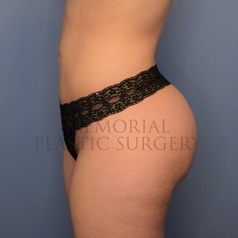 A side view after photo of patient 2519 that underwent Brazilian Butt Lift:Liposuction procedures at Memorial Plastic Surgery