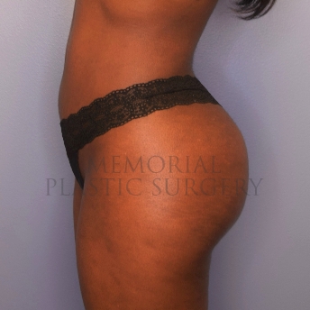 A side view after photo of patient 1413 that underwent Brazilian Butt Lift:Liposuction procedures at Memorial Plastic Surgery