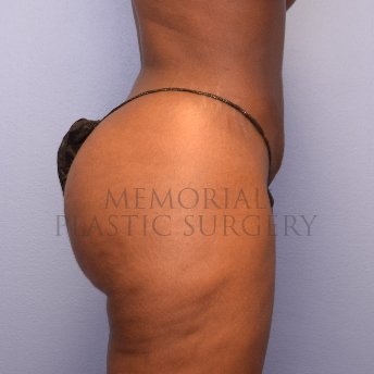 A side view after photo of patient 1267 that underwent Brazilian Butt Lift:Liposuction procedures at Memorial Plastic Surgery
