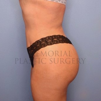 A side view after photo of patient 957 that underwent Brazilian Butt Lift:Liposuction procedures at Memorial Plastic Surgery