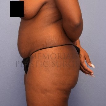 A side view before photo of patient 2674 that underwent Brazilian Butt Lift:Liposuction procedures at Memorial Plastic Surgery