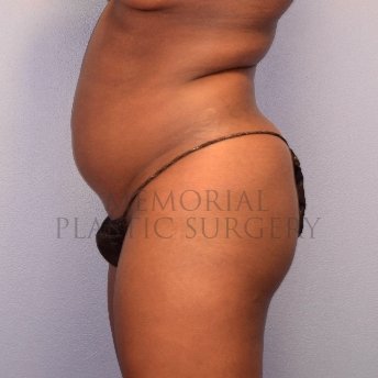 A side view before photo of patient 2652 that underwent Brazilian Butt Lift:Liposuction procedures at Memorial Plastic Surgery