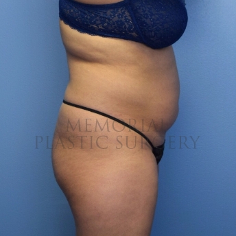 A side view before photo of patient 4107 that underwent Brazilian Butt Lift:Liposuction procedures at Memorial Plastic Surgery