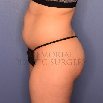 A side view before photo of patient 2519 that underwent Brazilian Butt Lift:Liposuction procedures at Memorial Plastic Surgery