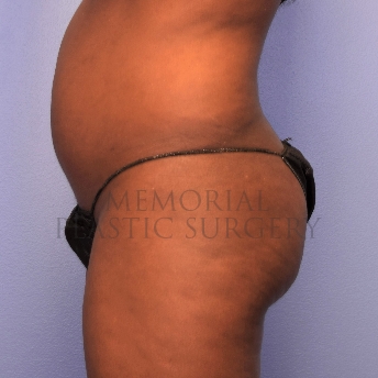 A side view before photo of patient 1413 that underwent Brazilian Butt Lift:Liposuction procedures at Memorial Plastic Surgery