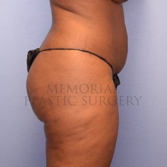 A side view before photo of patient 1267 that underwent Brazilian Butt Lift:Liposuction procedures at Memorial Plastic Surgery