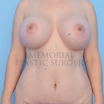 A front view after photo of patient 279 that underwent Breast Augmentation:Abdominoplasty Tummy Tuck:Liposuction procedures at Memorial Plastic Surgery