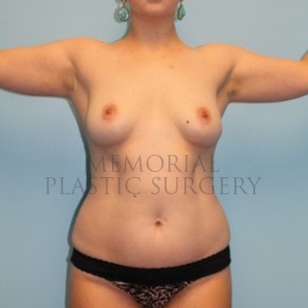 A front view before photo of patient 279 that underwent Breast Augmentation:Abdominoplasty Tummy Tuck:Liposuction procedures at Memorial Plastic Surgery