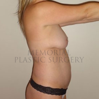 A side view before photo of patient 170 that underwent Breast Augmentation:Abdominoplasty Tummy Tuck:Liposuction procedures at Memorial Plastic Surgery
