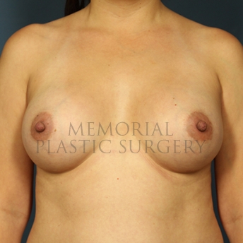 A front view after photo of patient 268 that underwent Breast Augmentation procedures at Memorial Plastic Surgery