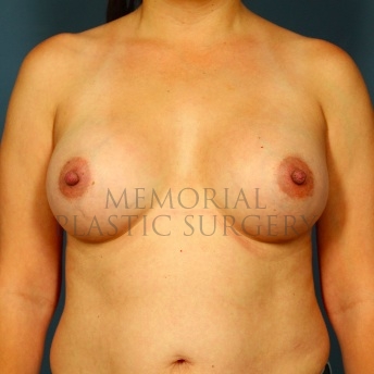 A front view after photo of patient 56 that underwent Breast Augmentation procedures at Memorial Plastic Surgery