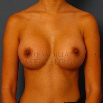 A front view after photo of patient 119 that underwent Breast Augmentation procedures at Memorial Plastic Surgery