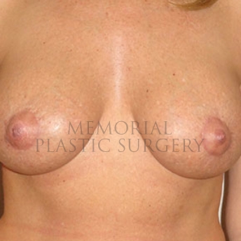 A front view after photo of patient 177 that underwent Breast Augmentation procedures at Memorial Plastic Surgery