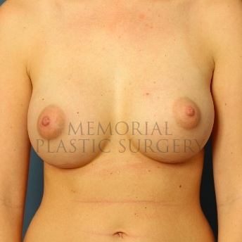 A front view after photo of patient 92 that underwent Breast Augmentation procedures at Memorial Plastic Surgery