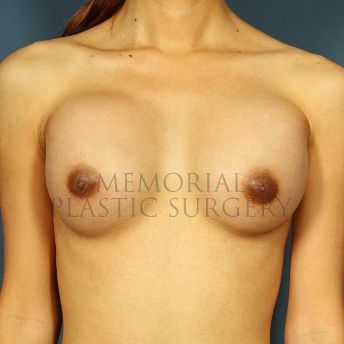 A front view after photo of patient 156 that underwent Breast Augmentation procedures at Memorial Plastic Surgery