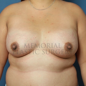 A front view after photo of patient 111 that underwent Breast Augmentation procedures at Memorial Plastic Surgery