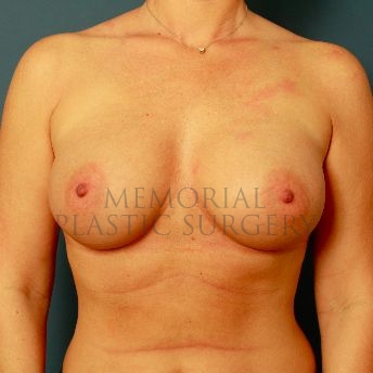 A front view after photo of patient 167 that underwent Breast Augmentation procedures at Memorial Plastic Surgery