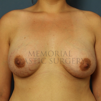 A front view after photo of patient 251 that underwent Breast Augmentation procedures at Memorial Plastic Surgery