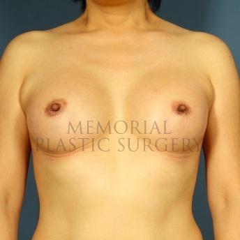A front view after photo of patient 69 that underwent Breast Augmentation procedures at Memorial Plastic Surgery
