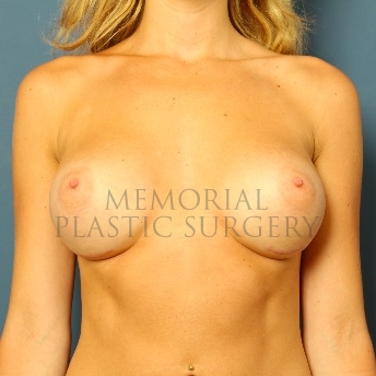 A front view after photo of patient 78 that underwent Breast Augmentation procedures at Memorial Plastic Surgery