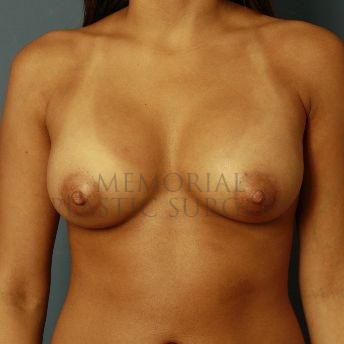 A front view after photo of patient 127 that underwent Breast Augmentation procedures at Memorial Plastic Surgery
