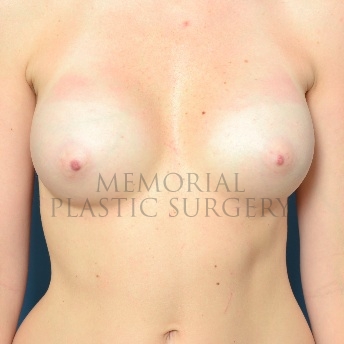 A front view after photo of patient 90 that underwent Breast Augmentation procedures at Memorial Plastic Surgery