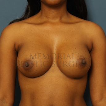 A front view after photo of patient 427 that underwent Breast Augmentation procedures at Memorial Plastic Surgery