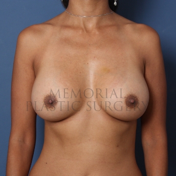 A front view after photo of patient 424 that underwent Breast Augmentation procedures at Memorial Plastic Surgery
