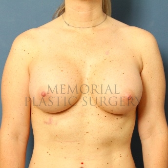 A front view after photo of patient 87 that underwent Breast Augmentation procedures at Memorial Plastic Surgery