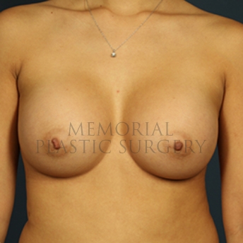 A front view after photo of patient 398 that underwent Breast Augmentation procedures at Memorial Plastic Surgery