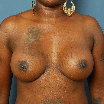 A front view after photo of patient 77 that underwent Breast Augmentation procedures at Memorial Plastic Surgery