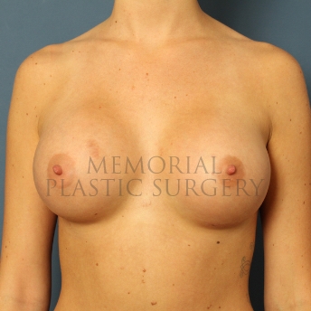 A front view after photo of patient 436 that underwent Breast Augmentation procedures at Memorial Plastic Surgery