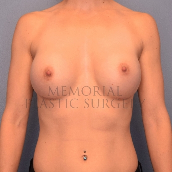 A front view after photo of patient 2420 that underwent Breast Augmentation procedures at Memorial Plastic Surgery